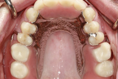 Partial upper denture