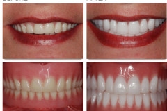 Full upper and lower dentures