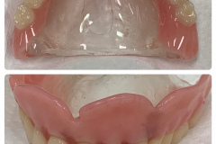 Clear palate upper denture