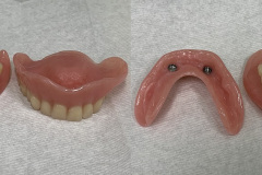 Full upper full lower overdenture