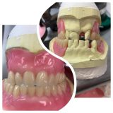 Full upper Full lower immediate dentures wax up