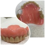 Partial maxillary acrylic with 2 retainers