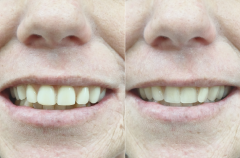 F/- denture