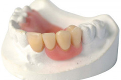 Maxillary cast model