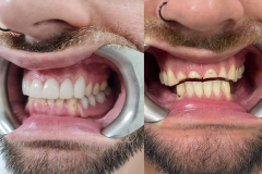 Upper anterior facings and part lower denture