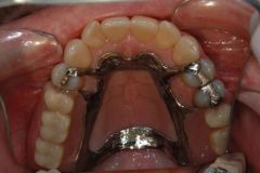 Partial upper denture