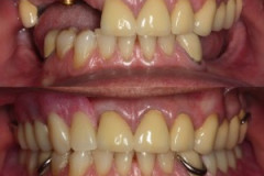 Partial upper and lower dentures